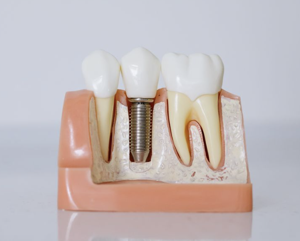 implantes dentales