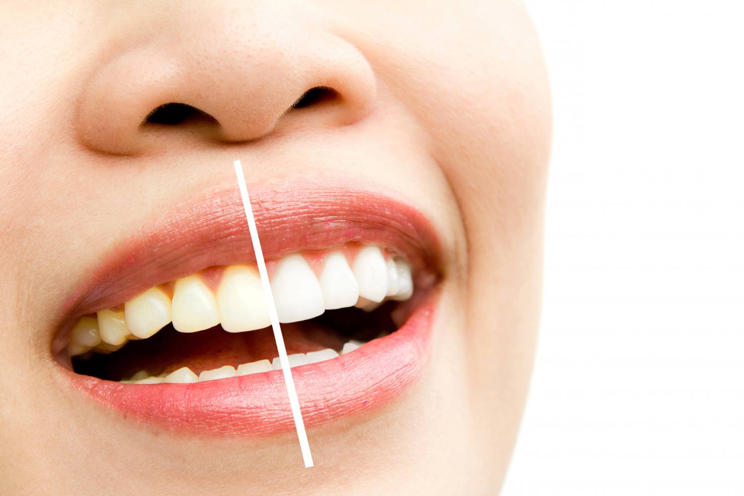 blanqueamiento dental valencia en Espai Dental Valencia