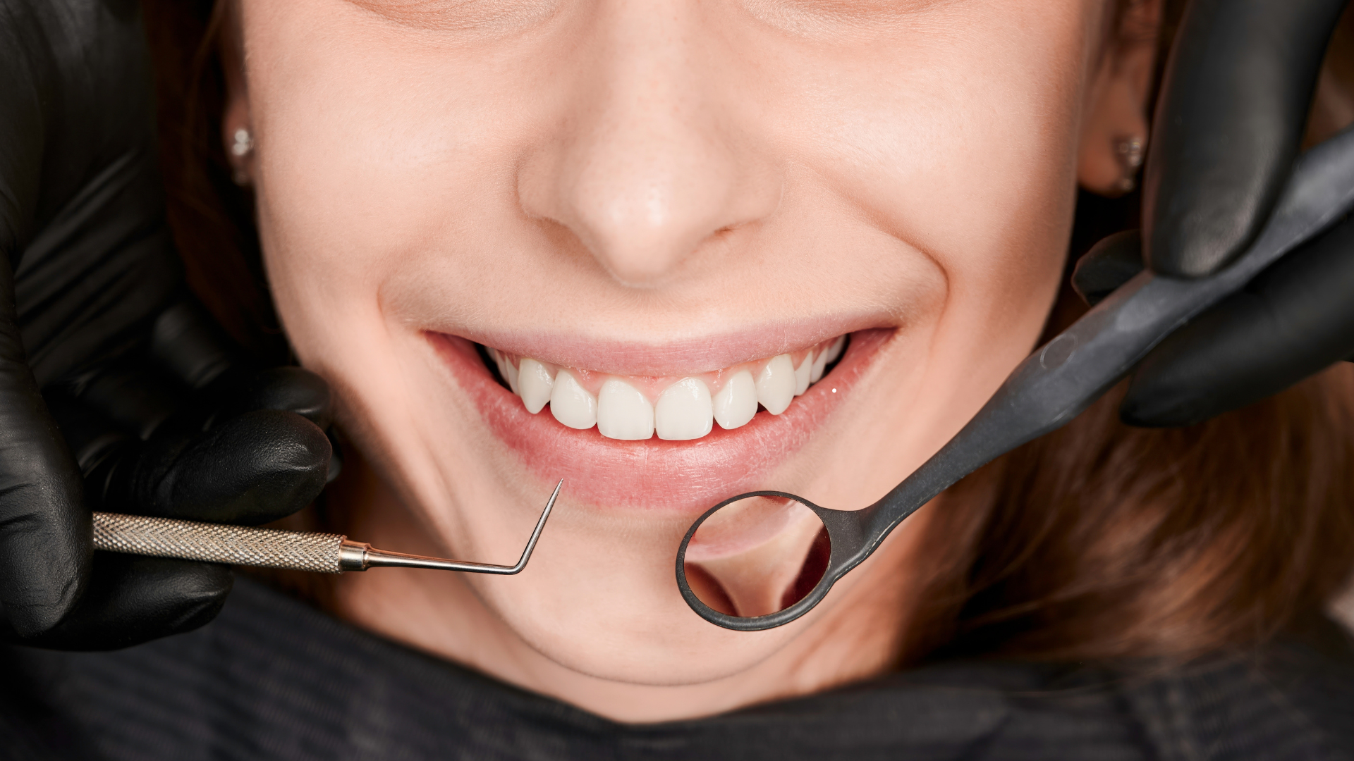 diseño de sonrisa valencia